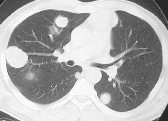 CT scan showing liver-metastatic cancer
